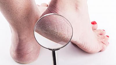 Cracked Heels Problem follow These Tips News In Hindi